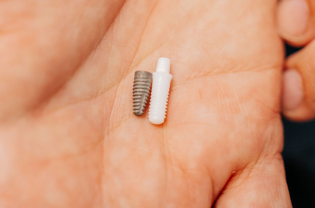 
Titanimplantat und metallfreies Keramikimplantat aus Zirkonoxid in einer Hand – Zahnarzt in Nürnberg, Implantatsysteme bei Dr. Alius & Kollegen in der Praxisklinik in der Mauthalle