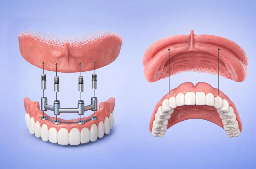 3D-Darstellung Vergleich implantatgetragene Vollprothese mit Steg und herkömmliche Vollprothese – Zahnarzt in Nürnberg, Praxisklinik in der Mauthalle