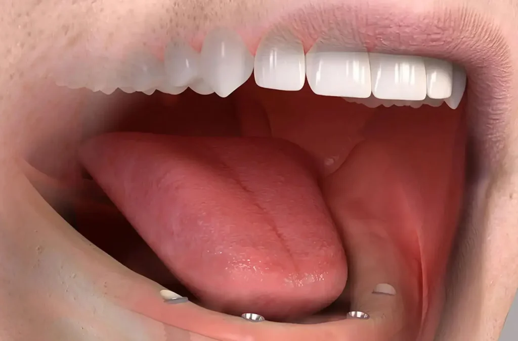 3D-Visualisierung: Einsetzen der Implantate im Unterkiefer für feste Zähne an einem Tag – Zahnarzt in Nürnberg, Praxisklinik in der Mauthalle